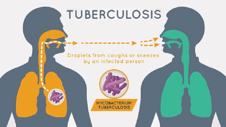tuberculosis - information
